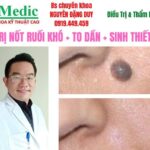 Mổ Cắt Nốt Ruồi Cà Mau An Toàn Chuẩn Y Khoa Cùng Bác Sĩ
