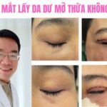 Thẩm mỹ mí mắt dư da thừa mỡ bọng mí Cà Mau an toàn y khoa