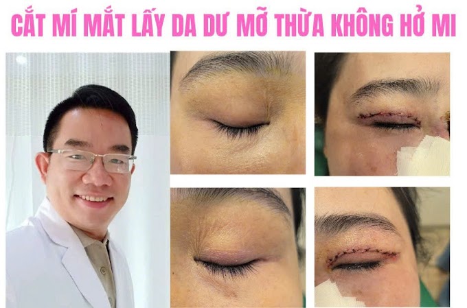 Thẩm mỹ mí mắt dư da thừa mỡ bọng mí Cà Mau an toàn y khoa