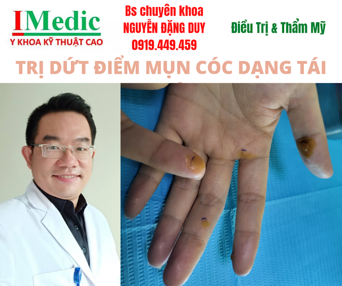 Trị mụn cóc dứt điểm tại Cà Mau bằng kỹ thuật cao an toàn