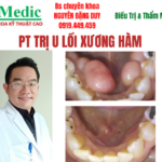 Trị u lồi xương hàm Cà Mau an toàn và hiệu quả cao