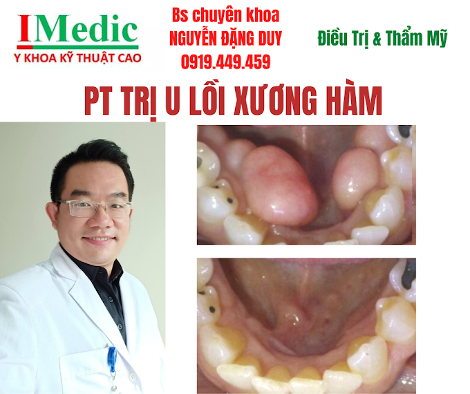 Trị u lồi xương hàm Cà Mau an toàn và hiệu quả cao